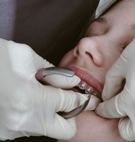 Ортодонтическая коррекция с применением брекет-системы 